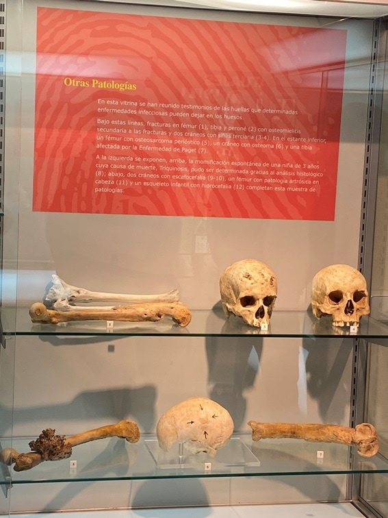 1 6 Crónica de una cautivadora visita al Museo de Antropología Médica-Forense ‘Profesor Reverte Coma’ 1 6 Crónica de una cautivadora visita al Museo de Antropología Médica-Forense ‘Profesor Reverte Coma’